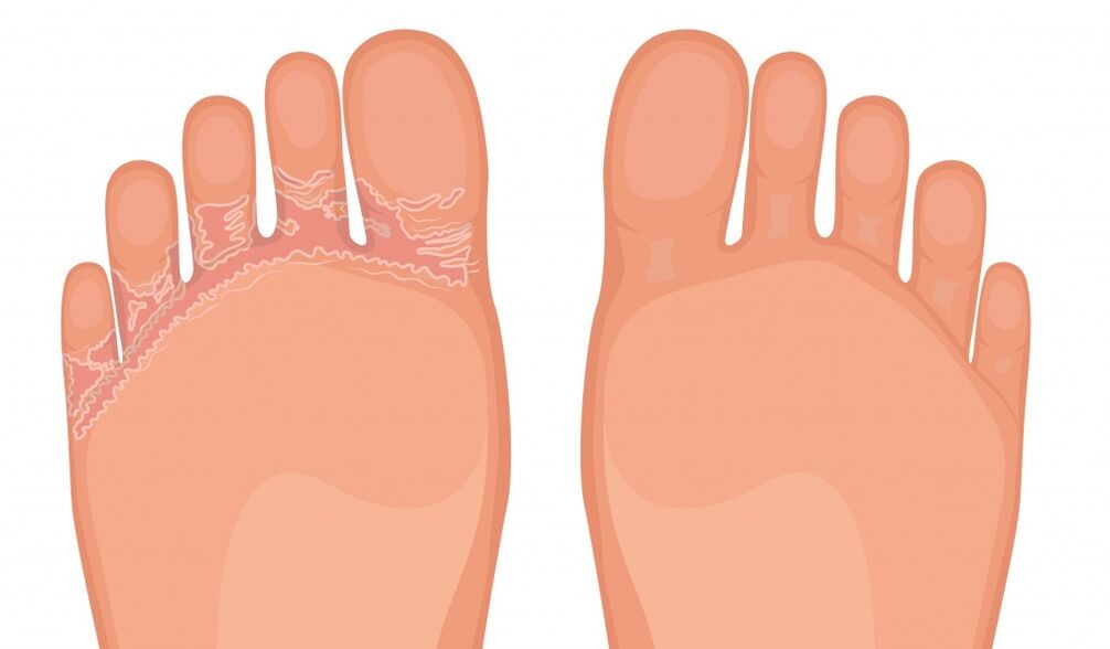 Fungent es eficaz contra todo tipo de hongos en los pies