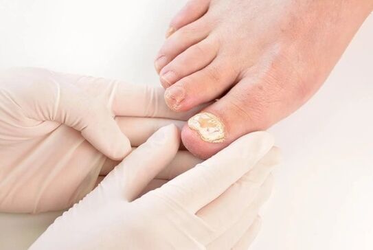 Los médicos recomiendan Fungent para el tratamiento del pie de atleta